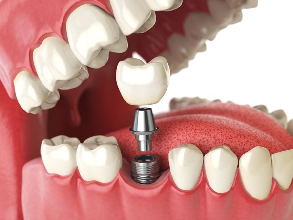 【種骨小百科：多久才可以種牙？植骨是種植牙手術的成功保障？】